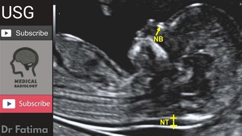 nuchal fold scan fetus